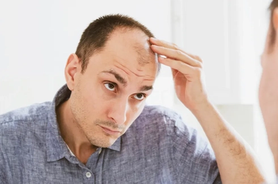 How to Find the Most Affordable Hair Transplant