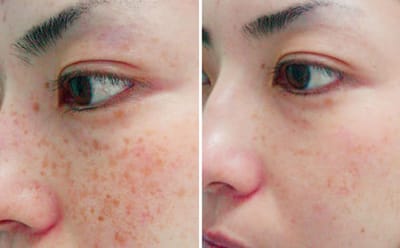 How Fast Does Pico Laser Treatment Work on Hyperpigmentation?