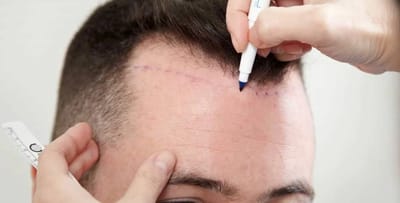 Low-Cost Hair Transplants: Are They Safe and Effective?