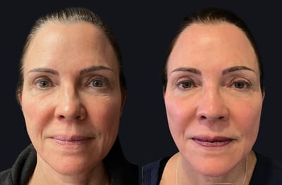 Fractional CO2 Laser for Scars: A Powerful Treatment for Smooth Skin