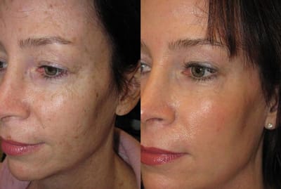 How Long Does Fractional CO2 Laser Treatment Take?