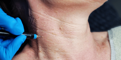 How to Remove Skin Tags Pain-Free: Tips & Tricks