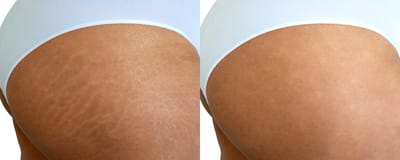 Fractional CO2 Laser Treatment for Stretch Marks: Everything You Need to Know