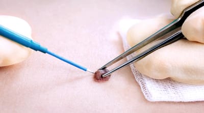 What’s the Best Price for Skin Wart Removal? A Guide to Costs