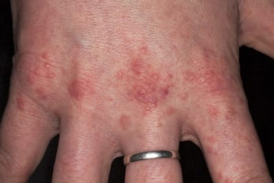 Top Benefits of Taking a Hepatitis C Test in Dubai