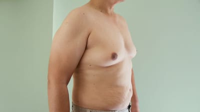 Why Does Gynecomastia Occur?