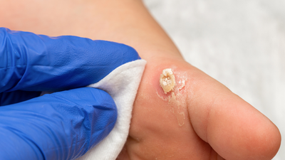 What to Expect From Your Skin Wart Removal Process