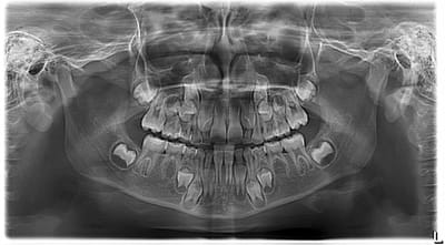 Panoramic Dental X-Ray for cost First-Time Patients
