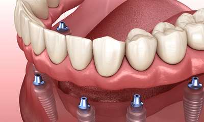 Tooth Extraction for Impacted Teeth