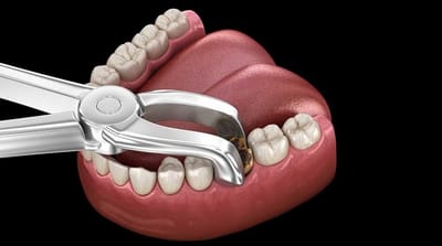 Tooth Extraction Cost for Orthodontic Preparation