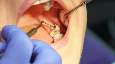 Emergency Tooth Extraction: Factors to Consider