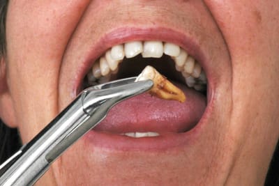 Tooth Extraction Cost: Simple vs. Surgical Extraction