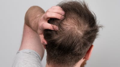 Finasteride 1mg Price and Generic Drug Quality: What to Ask