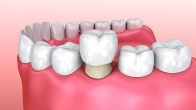 Are Dental Crowns and Bridges Right for You? Key Factors to Consider