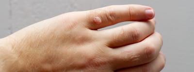 Skin Wart Removal Cost for Sensitive Skin Areas