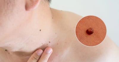 Skin Wart Removal Cost for Children vs. Adults
