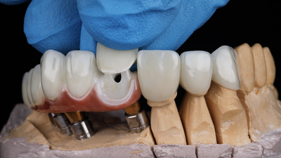 Comparing Porcelain vs Metal Dental Crowns and Bridges