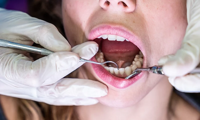 Tooth Filling Cost for Cracked or Chipped Teeth