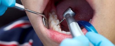 Tooth Filling Cost for Multiple Cavities