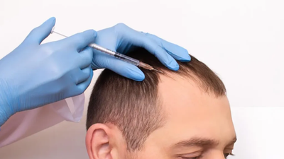Best PRP Hair Treatment for Early-Stage Hair Thinning