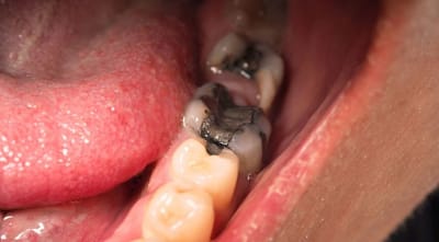 How Tooth Filling Cost Differs Between Silver and White Fillings