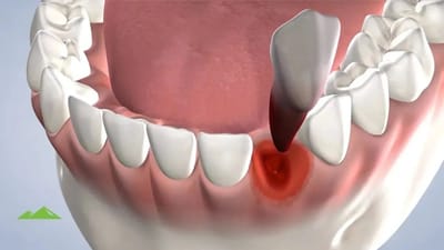 Tooth Extraction: What Makes an Extraction Difficult