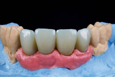 Dental Crowns and Bridges for Maintaining Jaw Alignment
