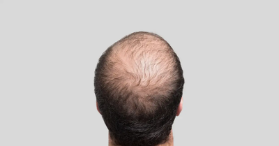 What Makes Front Line Hair Fixing Different From Wigs