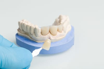 Dealing with Sensitivity After Dental Crowns and Bridges