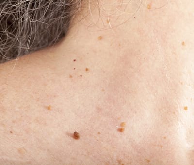 Skin Wart Removal Cost: How to Plan Ahead Financially