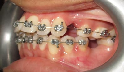Dental Braces for Overbite and Underbite Correction