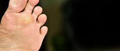 Skin Wart Removal Cost for Face vs. Body Warts