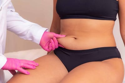 Liposuction for Men: Benefits and Considerations