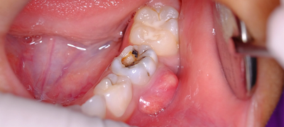 Tooth Removal and Swelling: Normal Healing Signs Explained