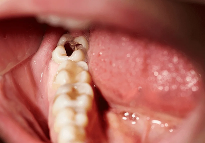 Pain Management After Wisdom Tooth Extraction