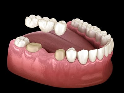 The Process of Installing Dental Crowns and Bridges
