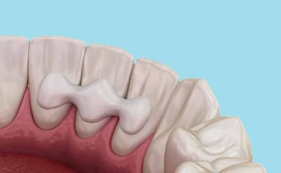Dental Crowns and Bridges: Addressing Multiple Tooth Loss