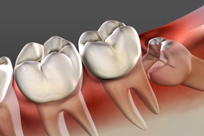 Wisdom Tooth Extraction Infection: Signs to Watch For