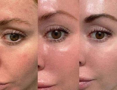 Profhilo Treatment: Hydration, Lifting, and Radiance in One