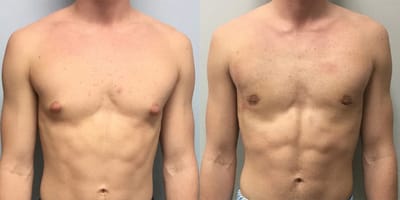 Gynecomastia Surgery Cost for Mild Cases