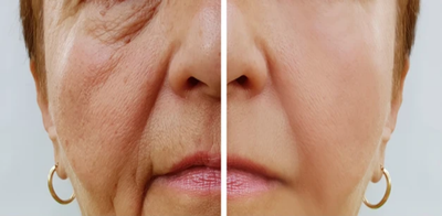 Profhilo Treatment for Fine Lines Around Eyes