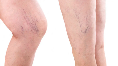 Beginner’s Guide to Spider Veins Treatment