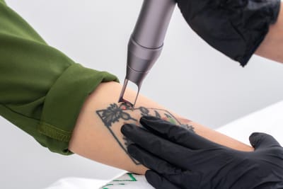 PicoSure Tattoo Removal: What Happens During Each Session