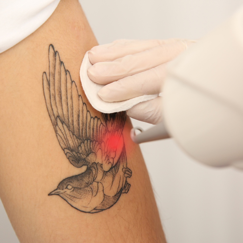 Remoção de Tatuagens