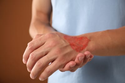 Magnétisme, coupeur de feu, brûlures, zona, traitements inflammatoires