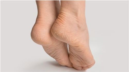 سر جفاف وتشقق القدمين في الشتاء: الدليل الشامل للعناية بالقدمين في الطقس البارد