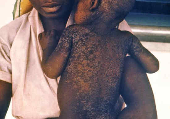 Nord-Kivu/Santé : Des enfants attaqués par l'épidémie de rougeole à Beni