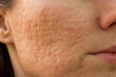 Cicatrici da Acne: una terapia personalizzata a seconda del grado