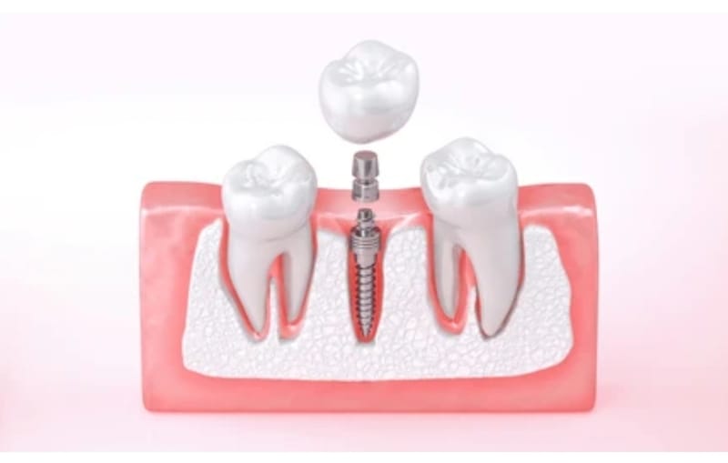 Coronas y prótesis sobre implantes