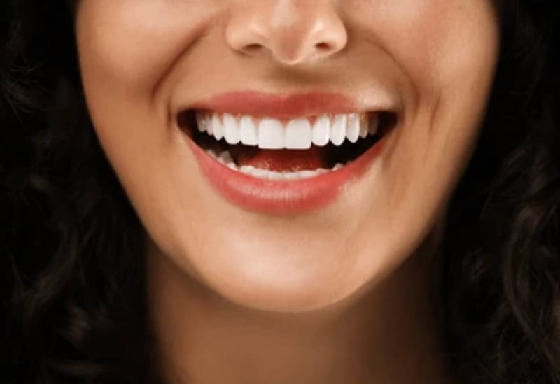 Blanqueamiento Dental